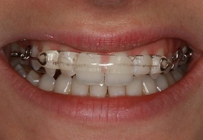 Nowoczesne leczenie ortodontyczne - jak to wyglda?